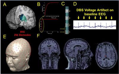 A Study on the Feasibility of the Deep Brain Stimulation (DBS) Electrode Localization Based on Scalp Electric Potential Recordings